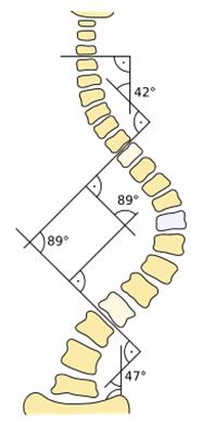 Befundgerechte Physiotherapie bei Skoliose