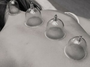 Praktische Durchführung des Schröpfen Praktische Durchführung des Schröpfen